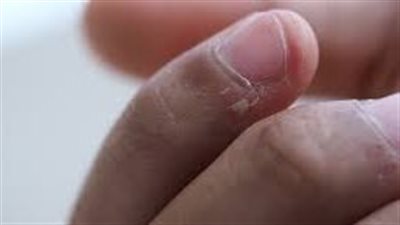 وداعاً للجلد المتشقق حول الأظافر: اكتشف الأسباب والعلاجات
