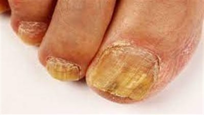 فطريات أظافر القدم: عدوى مزعجة وطرق فعّالة لعلاجها