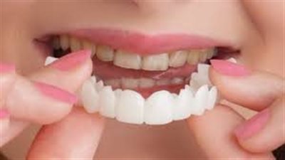 ابتسامة هوليود المتحركة: الحل السريع لابتسامة مثالية