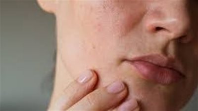 بشړة خالية من اللمعان: حلول طبيعية لعلاج البشرة الدهنية